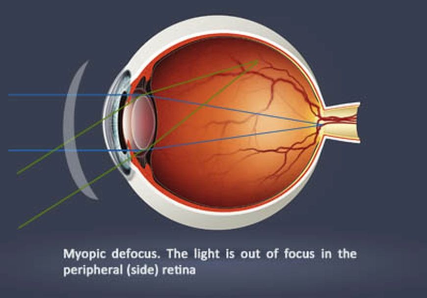 Improve Your Vision While You Sleep with Orthokeratology in Dubai Improve Your Vision While You Sleep with Orthokeratology in Dubai